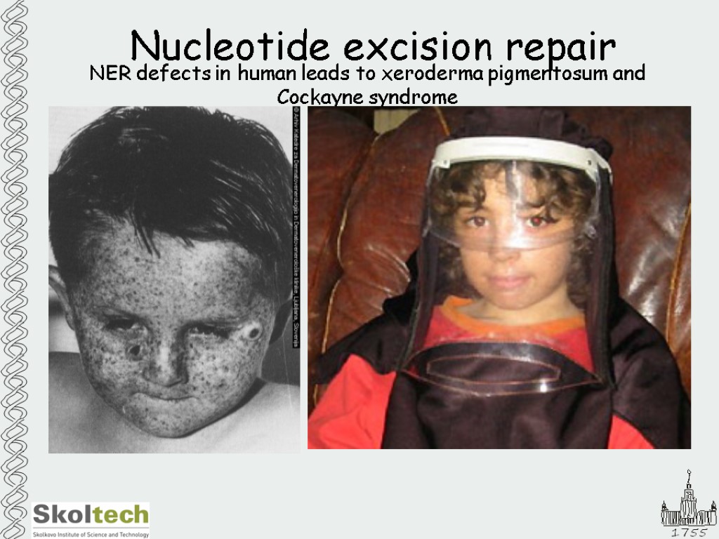 Nucleotide excision repair NER defects in human leads to xeroderma pigmentosum and Cockayne syndrome